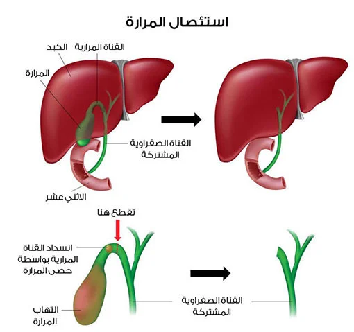 6 بدائل غذائية لتخفيف مشاكل الهضم بعد استئصال المرارة